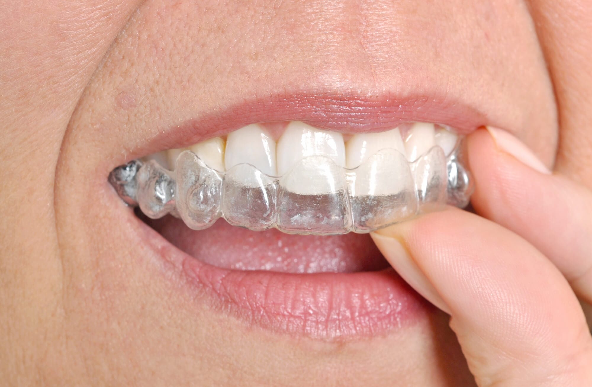 Invisalign-BI