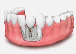 bone-grafting