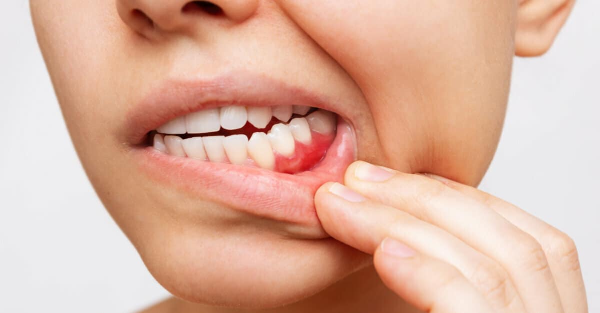Gum,Inflammation.,Cropped,Shot,Of,A,Young,Woman,Showing,Red